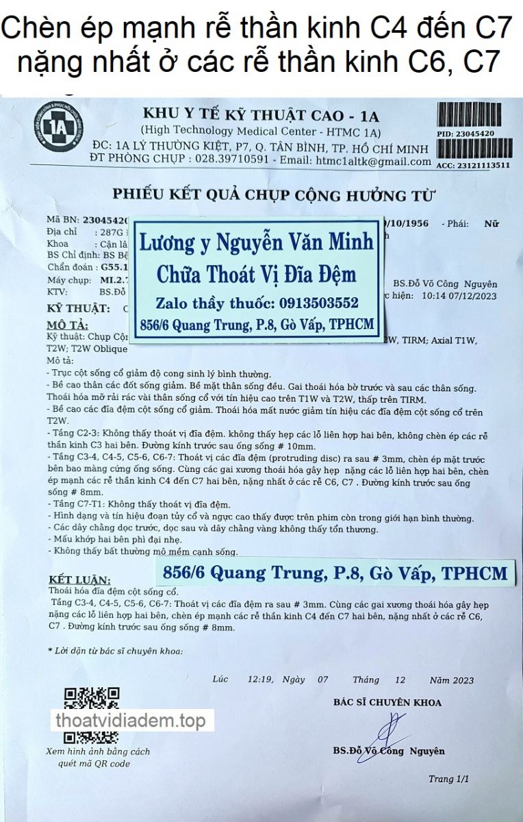 Chèn ép rễ thần kinh